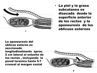 • La piel y la grasa
subcutanea es
disecada desde la
superficie anterior
de los rectos y la
aponeurosis de los
oblicuos externos
La aponeurosis del
oblicuo externo es
seccionado
longitudinalmente aprox.
2 cm lateral al estuche de
los rectos , incluyendo la
pared toracica hasta 5-7
craneal al margen costal
 