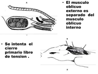 • Se intenta el
cierre
primario libre
de tension .
• El musculo
oblicuo
externo es
separado del
musculo
oblicuo
interno
 