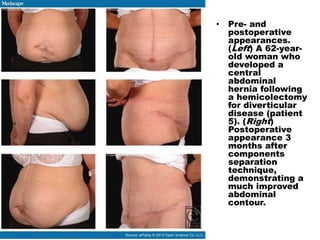 • Pre- and
postoperative
appearances.
(Left) A 62-year-
old woman who
developed a
central
abdominal
hernia following
a hemicolectomy
for diverticular
disease (patient
5). (Right)
Postoperative
appearance 3
months after
components
separation
technique,
demonstrating a
much improved
abdominal
contour.
 