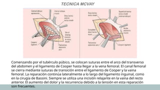 Mcvay Incision tecnicawdfefefeffeherniaeeumbilical.pptx