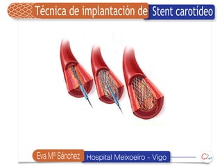 Técnica de implantación de Stent carotídeo




Eva Mª Sánchez   Hospital Meixoeiro - Vigo
 