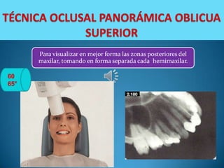 Para visualizar en mejor forma las zonas posteriores del
maxilar, tomando en forma separada cada hemimaxilar.
 