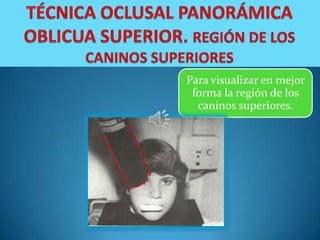 Para visualizar en mejor
 forma la región de los
  caninos superiores.
 