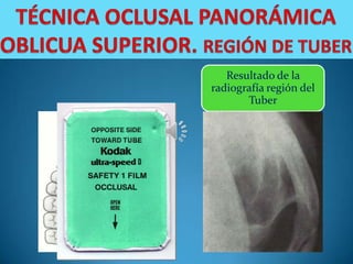 Resultado de la
radiografía región del
       Tuber
 