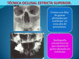 Cráneo con bloc
   de gomas
 plomadas por
 vestibular en
  zona alta de
  premolares.




  Radiografía
 oclusal estricta
 que muestra la
goma plomada en
   vestibular.
 