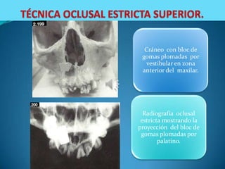 Cráneo con bloc de
 gomas plomadas por
  vestibular en zona
 anterior del maxilar.




  Radiografía oclusal
 estricta mostrando la
proyección del bloc de
 gomas plomadas por
        palatino.
 