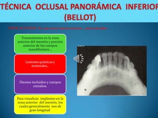 INDICACIONES: Es una muy buena técnica para estudiar :

       Traumatismos en la zona
     anterior del mentón y porción
        anterior de los cuerpos
            mandibulares ,.


          Lesiones quísticas y
              tumorales,.



      Dientes incluidos y cuerpos
               extraños.


    Para visualizar implantes en la
    zona anterior del mentón, los
     cuales generalmente son de
             gran longitud.
 