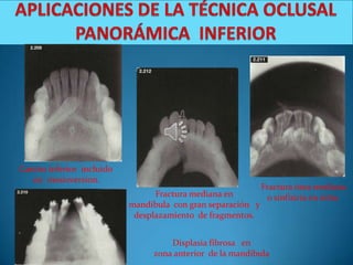 Canino inferior incluido
   en mesioversion.
                                                             Fractura ósea mediana
                                 Fractura mediana en           o sinfisiria en niño.
                           mandíbula con gran separación y
                            desplazamiento de fragmentos.


                                    Displasia fibrosa en
                                zona anterior de la mandíbula
 
