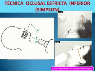 Rayo central: Cero
 grados, perpendicular al
     plano oclusal y a la
 película, dirigida al centro
           de ella.



 Variación Rx. oclusal estricta inf, el
plano de Frankfort no perpendicular
  al piso, se compensa dando una
 angulación negativa al rayo central



                                          Planno de frankfort no perpendicular al piso
 