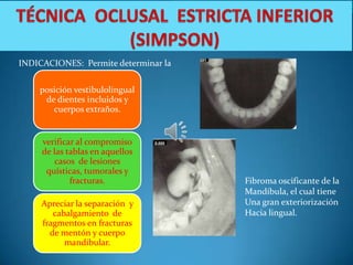 INDICACIONES: Permite determinar la


    posición vestibulolingual
     de dientes incluidos y
       cuerpos extraños.


     verificar al compromiso
     de las tablas en aquellos
        casos de lesiones
      quísticas, tumorales y
             fracturas.               Fibroma oscificante de la
                                      Mandíbula, el cual tiene
     Apreciar la separación y         Una gran exteriorización
        cabalgamiento de              Hacia lingual.
     fragmentos en fracturas
       de mentón y cuerpo
           mandibular.
 