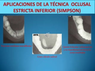 Fractura mediana mandibular                          Quiste folicular inflamatorio
                                                     y su manifestación hacia la
                                                           zona vestibular
                              Gran cálculo salival
 