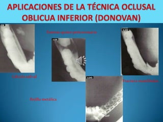 Extenso quiste pericoronario




Cálculo salival
                                                  Fractura mandibular.



          Rejilla metálica
 