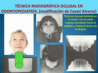 Película oclusal doblada en
   el medio con la parte
 rugosa orientada hacia el
paladar y hacia el dorso de
         la lengua
 