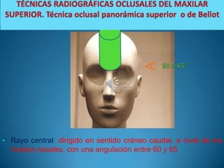 • Rayo central: dirigido en sentido cráneo caudal, a nivel de los
  huesos nasales, con una angulación entre 60 y 65
 