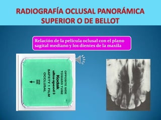 Relación de la película oclusal con el plano
sagital mediano y los dientes de la maxila
 