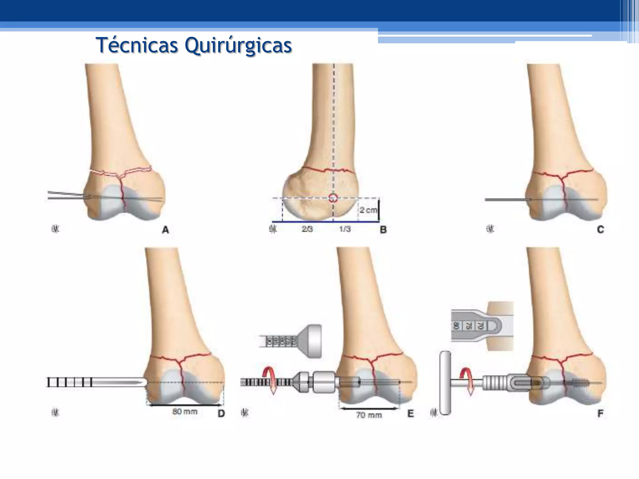 Femula Tecnica quirurgica. fx femur distal y patella | PPTX