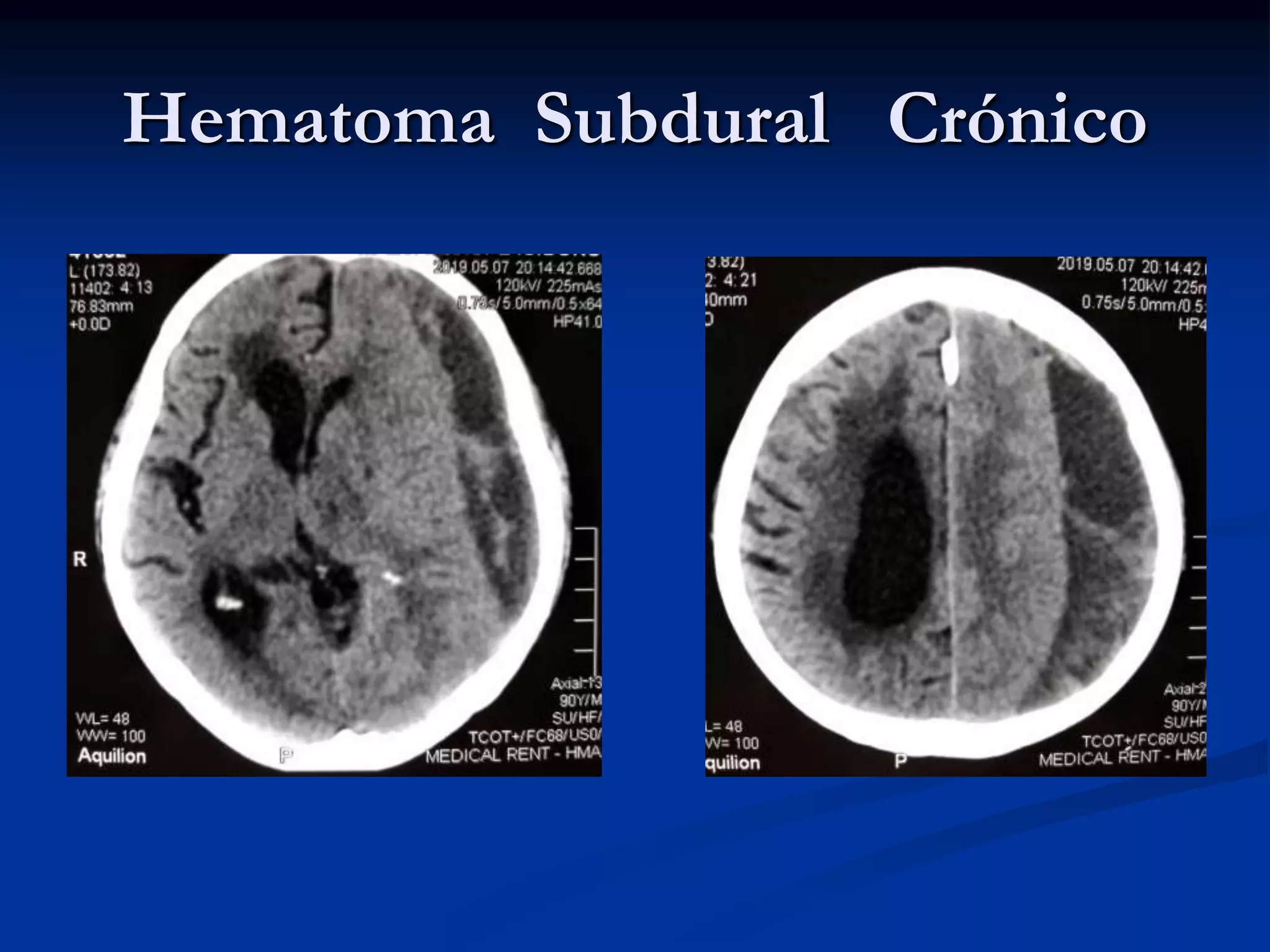 Técnica quirúrgica del Hematoma subdural crónico | PPT