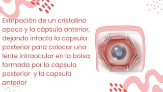 Extirpación de un cristalino
opaco y la cápsula anterior,
dejando intacta la capsula
posterior para colocar una
lente intraocular en la bolsa
formada por la capsula
posterior y la capsula
anterior
 