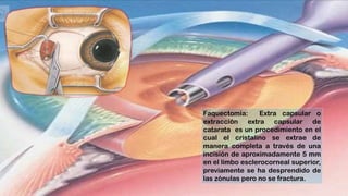 Faquectomía: Extra capsular o
extracción extra capsular de
catarata es un procedimiento en el
cual el cristalino se extrae de
manera completa a través de una
incisión de aproximadamente 5 mm
en el limbo esclerocorneal superior,
previamente se ha desprendido de
las zónulas pero no se fractura.
 
