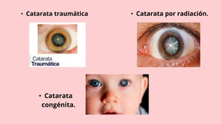 • Catarata traumática • Catarata por radiación.
• Catarata
congénita.
 
