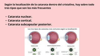 Según la localización de la catarata dentro del cristalino, hay sobre todo
tres tipos que son los más frecuentes
• Catarata nuclear.
• Catarata cortical.
• Catarata subcapsular posterior.
 