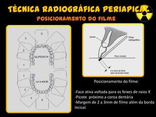 Técnica radiográfica periapical
Posicionamento do filme
Posicionamento do filme:
-Face ativa voltada para os feixes de raios X
-Picote próximo a coroa dentária
-Margem de 2 a 3mm de filme além da borda
incisal.
 