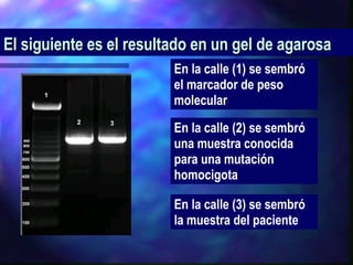 El siguiente es el resultado en un gel de agarosa   En la calle (1) se sembró el marcador de peso molecular En la calle (2) se sembró una muestra conocida para una mutación homocigota En la calle (3) se sembró la muestra del paciente  