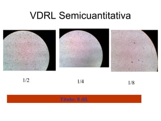 VDRL Semicuantitativa
1/2 1/4 1/8
Titulo: 8 dil.
 
