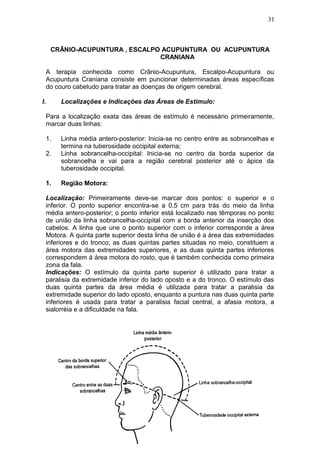 CRÂNIO-ACUPUNTURA , ESCALPO ACUPUNTURA OU ACUPUNTURA
CRANIANA
A terapia conhecida como Crânio-Acupuntura, Escalpo-Acupuntura ou
Acupuntura Craniana consiste em puncionar determinadas áreas específicas
do couro cabeludo para tratar as doenças de origem cerebral.
I. Localizações e Indicações das Áreas de Estímulo:
Para a localização exata das áreas de estímulo é necessário primeiramente,
marcar duas linhas:
1. Linha média antero-posterior: Inicia-se no centro entre as sobrancelhas e
termina na tuberosidade occipital externa;
2. Linha sobrancelha-occipital: Inicia-se no centro da borda superior da
sobrancelha e vai para a região cerebral posterior até o ápice da
tuberosidade occipital.
1. Região Motora:
Localização: Primeiramente deve-se marcar dois pontos: o superior e o
inferior. O ponto superior encontra-se a 0,5 cm para trás do meio da linha
média antero-posterior; o ponto inferior está localizado nas têmporas no ponto
de união da linha sobrancelha-occipital com a borda anterior da inserção dos
cabelos. A linha que une o ponto superior com o inferior corresponde a área
Motora. A quinta parte superior desta linha de união é a área das extremidades
inferiores e do tronco; as duas quintas partes situadas no meio, constituem a
área motora das extremidades superiores, e as duas quinta partes inferiores
correspondem á área motora do rosto, que é também conhecida como primeira
zona da fala.
Indicações: O estímulo da quinta parte superior é utilizado para tratar a
paralisia da extremidade inferior do lado oposto e a do tronco. O estímulo das
duas quinta partes da área média é utilizada para tratar a paralisia da
extremidade superior do lado oposto, enquanto a puntura nas duas quinta parte
inferiores é usada para tratar a paralisia facial central, a afasia motora, a
sialorréia e a dificuldade na fala.
31
 