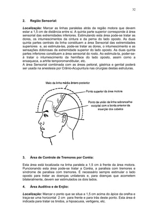 2. Região Sensorial:
Localização: Marcar as linhas paralelas atrás da região motora que devem
estar a 1,5 cm de distância entre si. A quinta parte superior corresponde á área
sensorial das extremidades inferiores. Estimulando esta área pode-se tratar as
dores, os intumescimentos da cintura e da perna do lado oposto. As duas
quinta partes centrais da linha constituem a área Sensorial das extremidades
superiores e, ao estimula-las, pode-se tratar as dores, o intumescimento e as
sensações dolorosas da extremidade superior do lado oposto. As duas quinta
partes inferiores constituem a área sensorial do rosto. Ao estimula-la, poder-se-
á tratar o intumescimento da hemiface do lado oposto, assim como a
enxaqueca, a artrite temporomandibular, etc.
A área Sensorial combinada com as áreas peitoral, gástrica e genital poderá
ser usada na anestesia por Crânio-Acupuntura nas cirurgias destas estruturas.
3. Área de Controle de Tremores por Coréia:
Esta área está localizada na linha paralela a 1,5 cm à frente da área motora.
Puncionando esta área pode-se tratar a Coréia, a paralisia com tremores e
síndrome de paralisia com tremores. É necessário sempre estimular o lado
oposto para tratar as doenças unilaterais e, para doenças que acometem
bilateralmente, devem ser estimulados os dois lados.
4. Área Auditiva e de Enjôo:
Localização: Marcar o ponto que se situa a 1,5 cm acima do ápice da orelha e
traça-se uma horizontal 2 cm para frente e para trás deste ponto. Esta área é
indicada para tratar os tinidos, a hipoacusia, vertigens, etc.
32
 