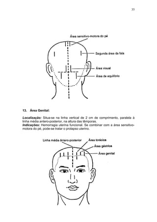 13. Área Genital:
Localização: Situa-se na linha vertical de 2 cm de comprimento, paralela à
linha média antero-posterior, na altura das têmporas.
Indicações: Hemorragia uterina funcional. Se combinar com a área sensitivo-
motora do pé, pode-se tratar o prolapso uterino.
35
 