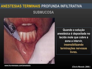 ANESTESIAS TERMINAIS PROFUNDA INFILTRATIVA
SUBMUCOSA
Quando a solução
anestésica é depositada no
tecido mole que cobre a
zona a intervir,
insensibilizando
terminações nervosas
livres.
www.hs-menezes.com/anestesia
(Clovis Marzola ;2000 )
 