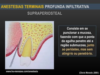 SUPRAPERIOSTEAL
ANESTESIAS TERMINAIS PROFUNDA INFILTRATIVA
Consiste em se
puncionar a mucosa,
fazendo com que a ponta
da agulha penetre até a
região submucosa, junto
ao periósteo, mas sem
atingi-lo ou penetrá-lo.
www.hs-menezes.com/anestesia (Clovis Marzola ;2000 )
 