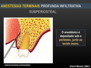 SUBPERIOSTEAL
ANESTESIAS TERMINAIS PROFUNDA INFILTRATIVA
O anestésico é
depositado sob o
periósteo, junto ao
tecido ósseo.
www.hs-menezes.com/anestesia
(Clovis Marzola ;2000 )
 