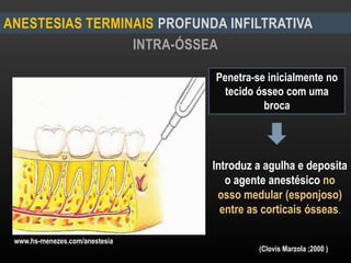 INTRA-ÓSSEA
ANESTESIAS TERMINAIS PROFUNDA INFILTRATIVA
Penetra-se inicialmente no
tecido ósseo com uma
broca
Introduz a agulha e deposita
o agente anestésico no
osso medular (esponjoso)
entre as corticais ósseas.
(Clovis Marzola ;2000 )
www.hs-menezes.com/anestesia
 
