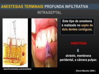 INTRASEPTAL
ANESTESIAS TERMINAIS PROFUNDA INFILTRATIVA
www.hs-menezes.com/anestesia
Este tipo de anestesia
é realizado no septo de
dois dentes contíguos.
ANESTESIA
alvéolo, membrana
peridental, e câmara pulpar.
(Clovis Marzola ;2000 )
 