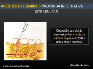 INTRAPULPAR
ANESTESIAS TERMINAIS PROFUNDA INFILTRATIVA
Deposição da solução
anestésica diretamente na
câmara pulpar, com fortes
dores para o paciente.
(Clovis Marzola ;2000 )www.hs-menezes.com/anestesia
 
