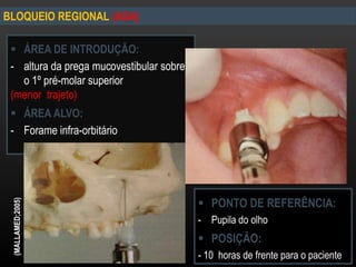  ÁREA DE INTRODUÇÃO:
- altura da prega mucovestibular sobre
o 1º pré-molar superior
(menor trajeto)
 ÁREA ALVO:
- Forame infra-orbitário
BLOQUEIO REGIONAL (ASA)(MALLAMED;2005)
 PONTO DE REFERÊNCIA:
- Pupila do olho
 POSIÇÃO:
- 10 horas de frente para o paciente
 