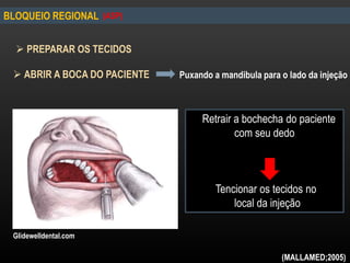  PREPARAR OS TECIDOS
Retrair a bochecha do paciente
com seu dedo
Tencionar os tecidos no
local da injeção
 ABRIR A BOCA DO PACIENTE
BLOQUEIO REGIONAL
Puxando a mandibula para o lado da injeção
(ASP)
(MALLAMED;2005)
Glidewelldental.com
 