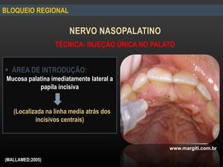 BLOQUEIO REGIONAL
NERVO NASOPALATINO
 ÁREA DE INTRODUÇÃO:
Mucosa palatina imediatamente lateral a
papila incisiva
(Localizada na linha media atrás dos
incisivos centrais)
TÉCNICA- INJEÇÃO ÚNICA NO PALATO
(MALLAMED;2005)
www.margiti.com.br
 