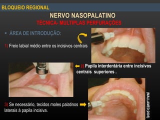  ÁREA DE INTRODUÇÃO:
1) Freio labial médio entre os incisivos centrais
3) Se necessário, tecidos moles palatinos
laterais à papila incisiva.
BLOQUEIO REGIONAL
NERVO NASOPALATINO
TÉCNICA- MULTIPLAS PERFURAÇÕES
(MALLAMED;2005)
2) Papila interdentária entre incisivos
centrais superiores .
 