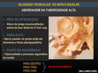 BLOQUEIO TRONCULAR DO NERVO MAXILAR
ABORDAGEM DA TUBEROSIDADE ALTA
 ÁREA DE INTRODUÇÃO:
- Altura da prega mucovestibular,
acima da face distal do 2°mol. sup.
 ÁREA-ALVO:
- Nervo maxilar no ponto onde ele
atravessa a fossa pterigopalatina
 PONTO DE REFERÊNCIA:
- Tuberosidade e processo zigomático
da maxila
PARA DENTRO
PARA TRÁS
PARA CIMA
EM UM SÓ MOVIMENTO
(MALLAMED;2005)
 