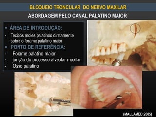 BLOQUEIO TRONCULAR DO NERVO MAXILAR
ABORDAGEM PELO CANAL PALATINO MAIOR
 ÁREA DE INTRODUÇÃO:
- Tecidos moles palatinos diretamente
sobre o forame palatino maior
 PONTO DE REFERÊNCIA:
- Forame palatino maior
- junção do processo alveolar maxilar
- Osso palatino
(MALLAMED;2005)
 