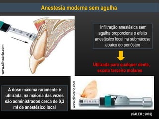 Anestesia moderna sem agulha
Infiltração anestésica sem
agulha proporciona o efeito
anestésico local na submucosa
abaixo do periósteo
A dose máxima raramente é
utilizada, na maioria das vezes
são administrados cerca de 0,3
ml de anestésico local
Utilizada para qualquer dente,
exceto terceiro molares
www.clinicario.com
(SALEH ; 2002)
www.clinicario.com
 