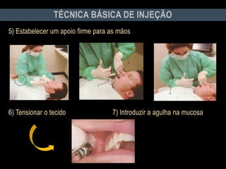 5) Estabelecer um apoio firme para as mãos
6) Tensionar o tecido 7) Introduzir a agulha na mucosa
TÉCNICA BÁSICA DE INJEÇÃO
 