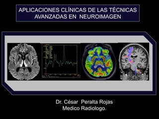APLICACIONES CLÍNICAS DE LAS TÉCNICAS
AVANZADAS EN NEUROIMAGEN
Dr. César Peralta Rojas
Medico Radiologo.
 