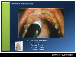 Técnicas de Anestesia Local




                     Referencias anatómicas.
                     Técnica básica
                        Punción directa.
                        Punción indirecta.
                        Punción anterior

                                                CD MARCOS NOVOA HERRERA
 