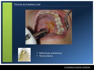 Técnicas de Anestesia Local




                       Referencias anatómicas.
                       Técnica básica



                                                  CD MARCOS NOVOA HERRERA
 
