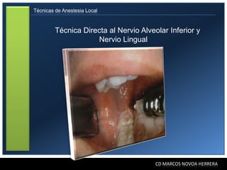 Técnicas de Anestesia Local



         Técnica Directa al Nervio Alveolar Inferior y
                     Nervio Lingual




                                        CD MARCOS NOVOA HERRERA
 