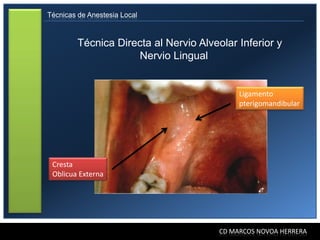 Técnicas de Anestesia Local



         Técnica Directa al Nervio Alveolar Inferior y
                     Nervio Lingual


                                             Ligamento
                                             pterigomandibular




 Cresta
 Oblicua Externa




                                        CD MARCOS NOVOA HERRERA
 